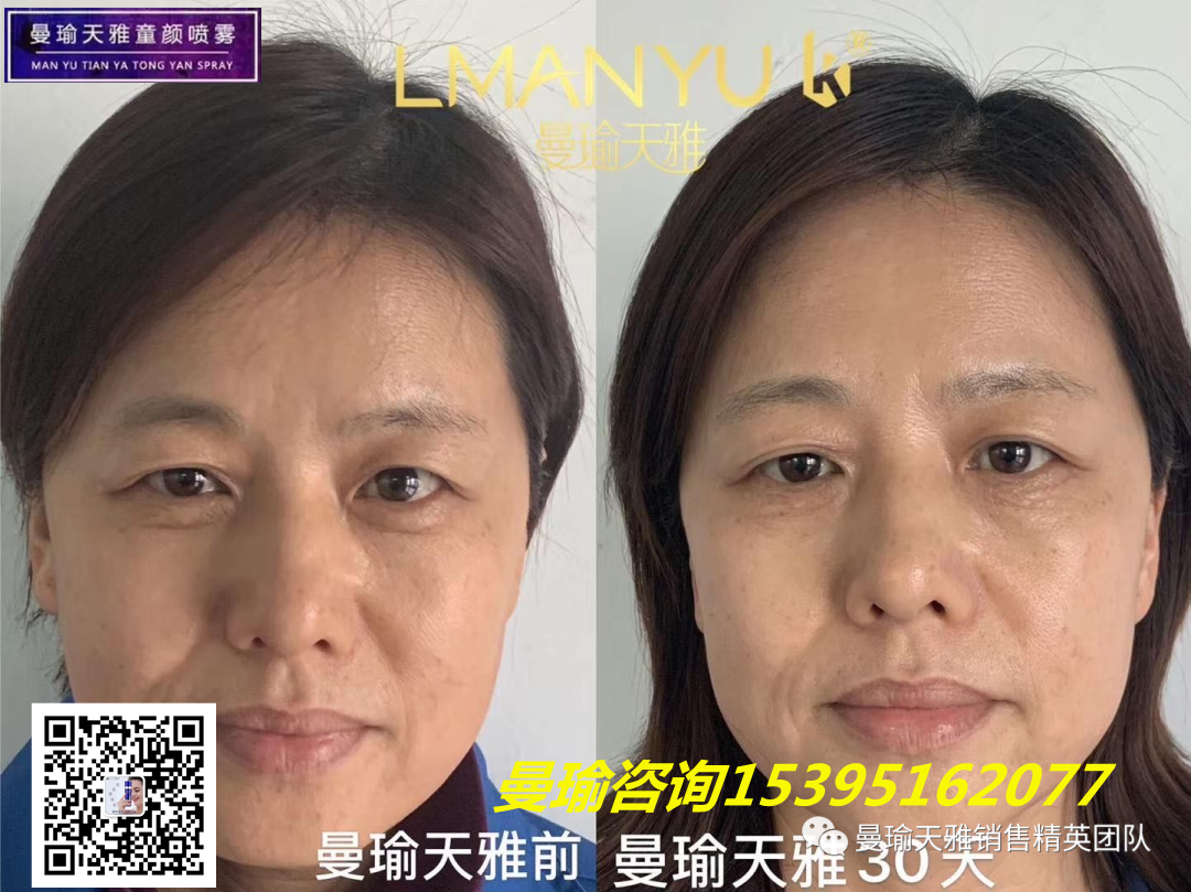 皮肤瘙痒 皮肤痘痘，用什么护肤品？曼瑜天雅童颜喷雾效果好