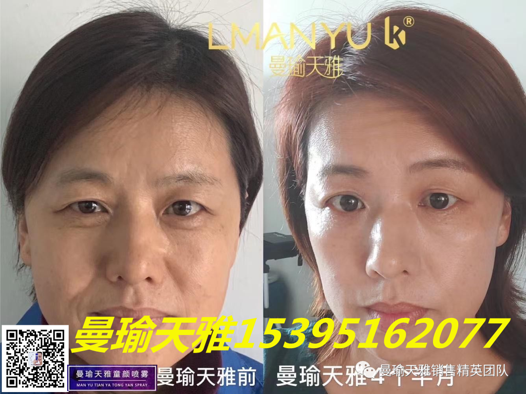 皮肤瘙痒 皮肤痘痘，用什么护肤品？曼瑜天雅童颜喷雾效果好