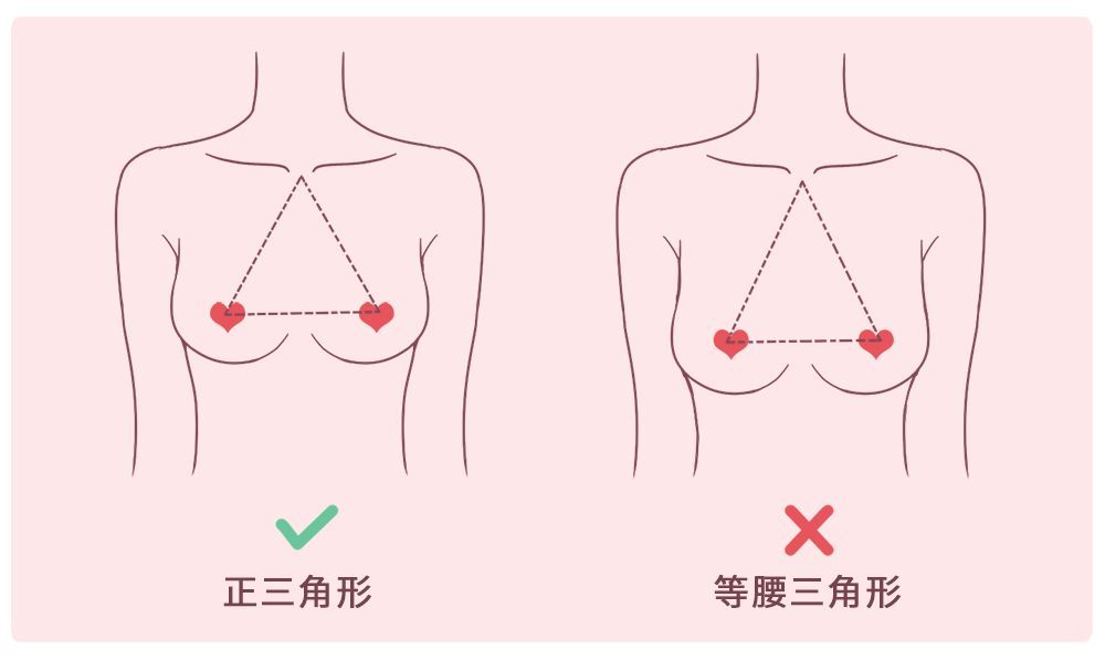 刘燕酿制：胸外扩是什么原因造成的？胸外扩如何改善？