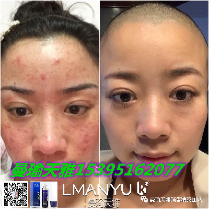 --祛痘，祛痘印，曼瑜天雅童颜喷雾真的有那么好吗？